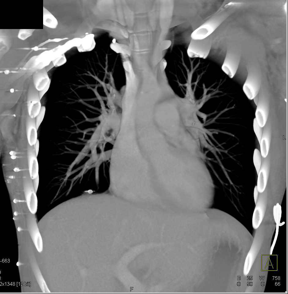 GSW with Chest Wall Pellets and in Lung - CTisus CT Scan