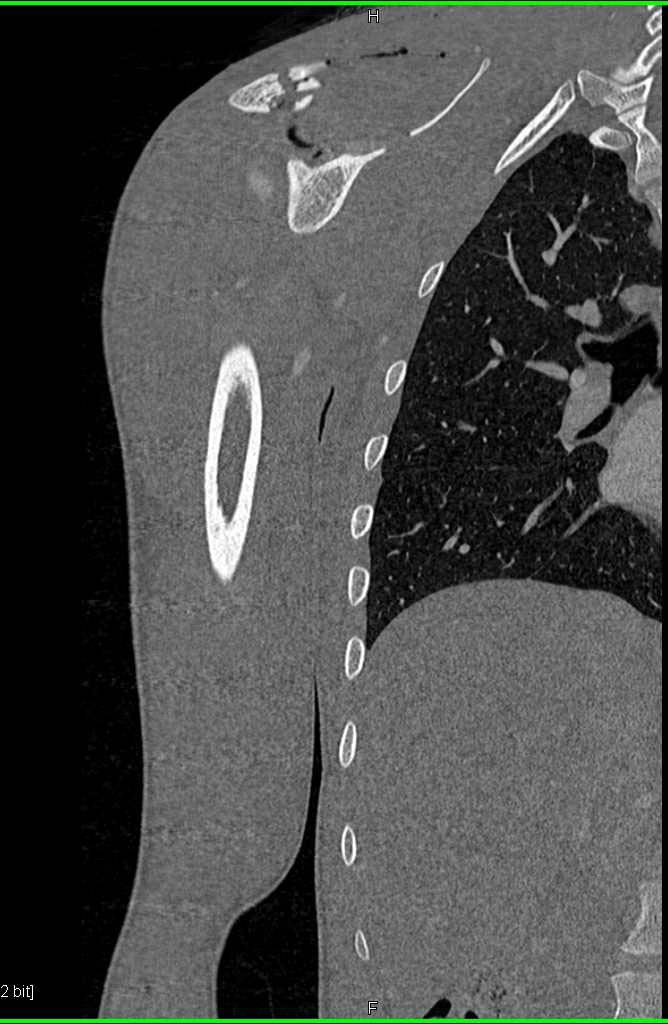 Scapular Fracture due to GSW - CTisus CT Scan