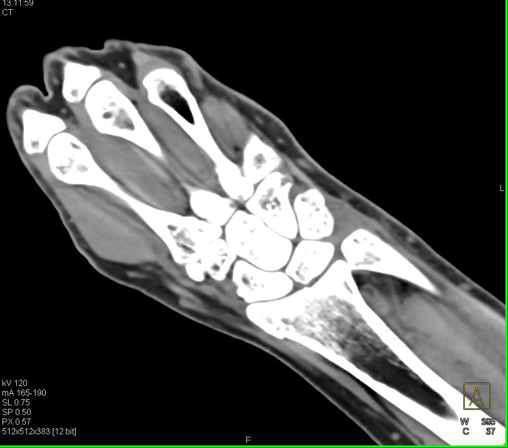 Fracture Involves Distal Radius and Navicular - CTisus CT Scan