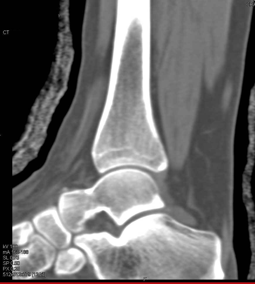 Fracture of the Talus - CTisus CT Scan