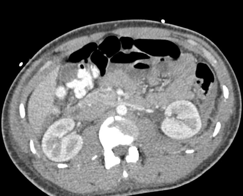 Left Pelvic Fracture with Uretral  Injury - CTisus CT Scan