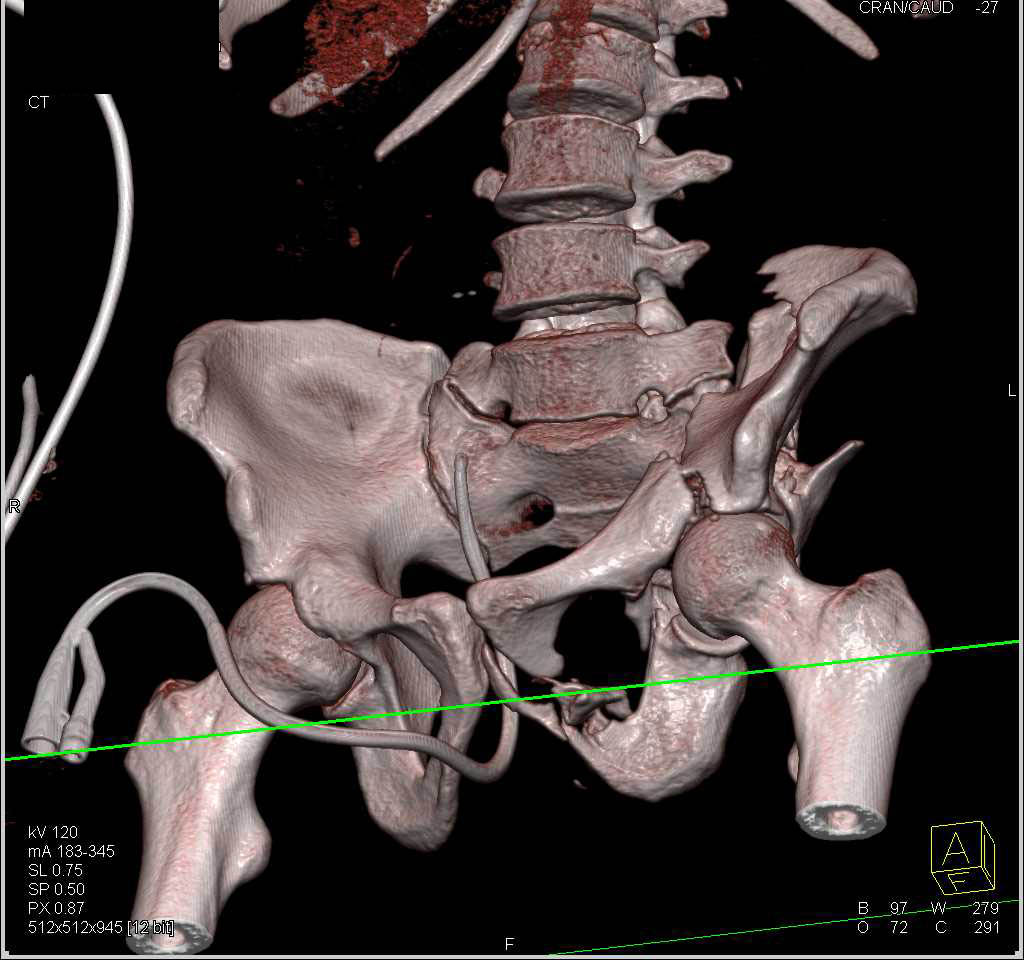 Multiple Fractures Involving the Left Hemipelvis Including Acetabulum and Iliac Wing - CTisus CT Scan