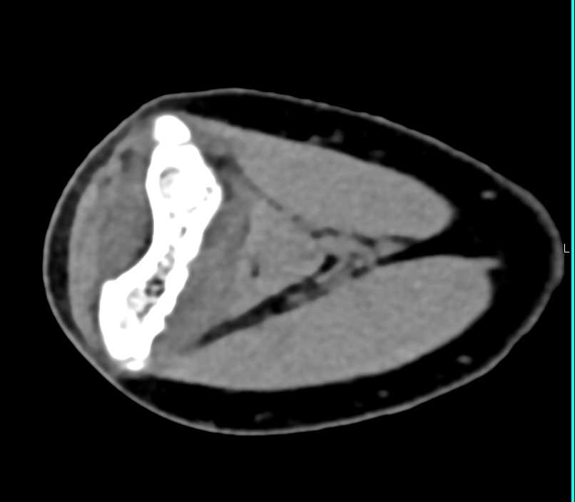 Olecranon Fracture with Soft Tissue injury - CTisus CT Scan
