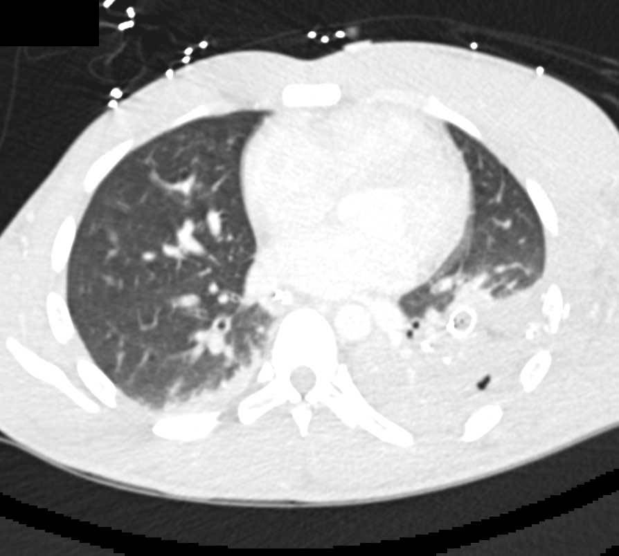 Hemorrhage in the Left Pleural Space Following Trauma - CTisus CT Scan