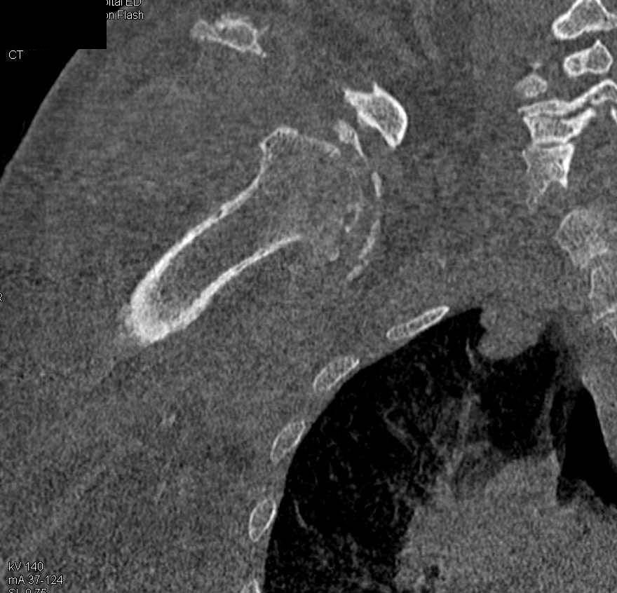 Fracture Dislocation of the Shoulder With  Evidence of Repeated Dislocations - CTisus CT Scan