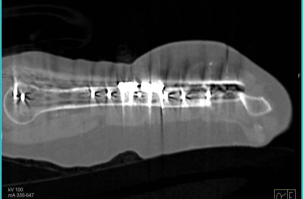 Fracture Humerus Through Hardware from Prior Repair - CTisus CT Scan