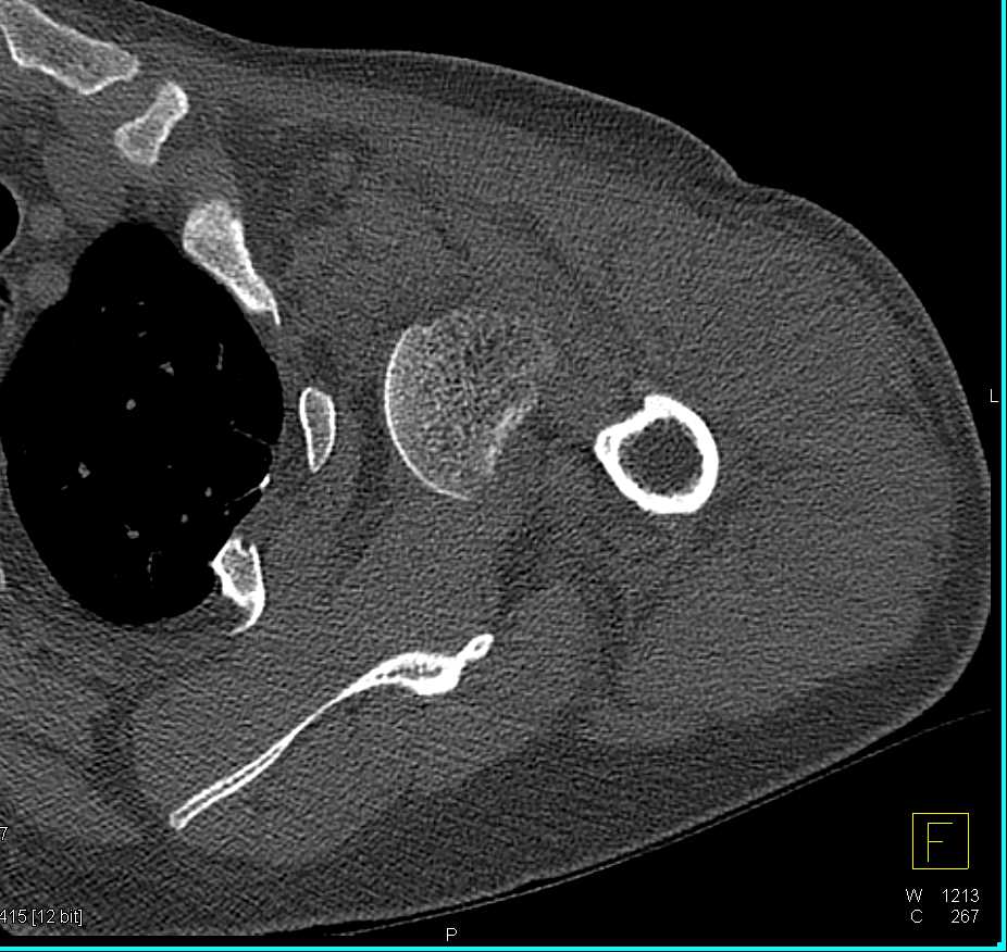 Fracture-Dislocation Left Shoulder - CTisus CT Scan