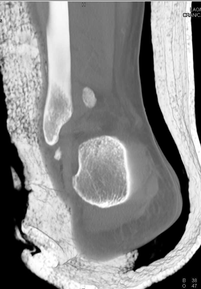 Complex Fracture Dislocation with Talus and Calcaneus Fractures - CTisus CT Scan