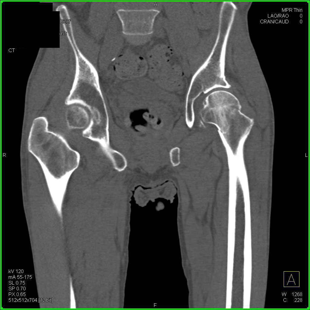 left femoral neck fracture icd10