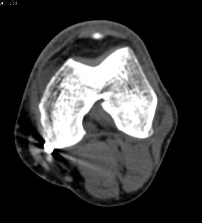 GSW to Knee with Muscle and Soft Tissue Injury - CTisus CT Scan