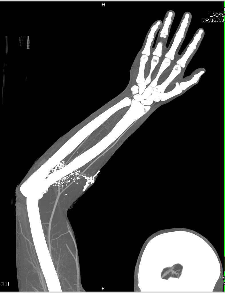 GSW Arm with Soft Tissue and Muscle Injury - CTisus CT Scan