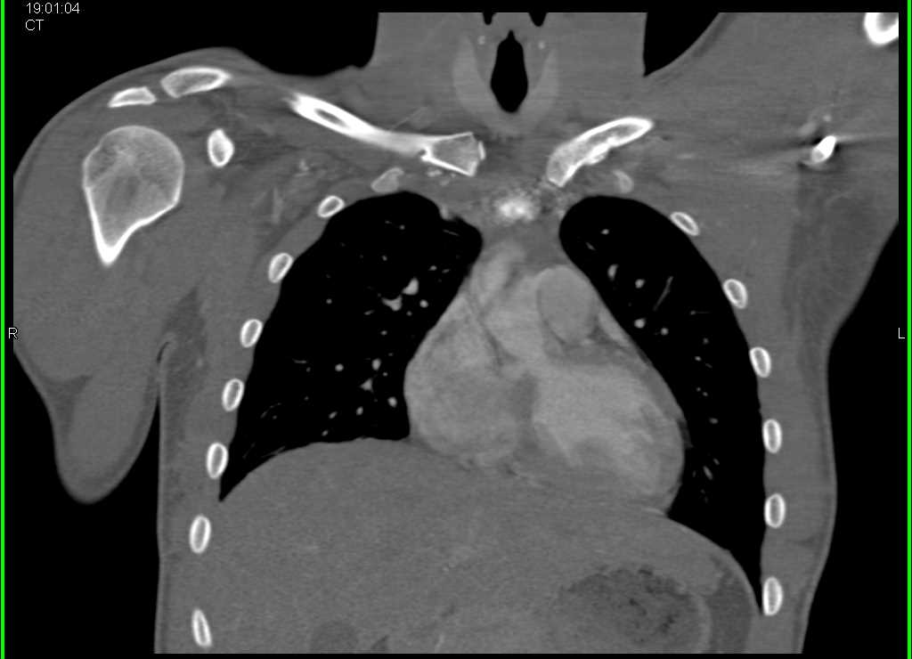 Chest Trauma with Clavicle-Sternal Dislocation - CTisus CT Scan