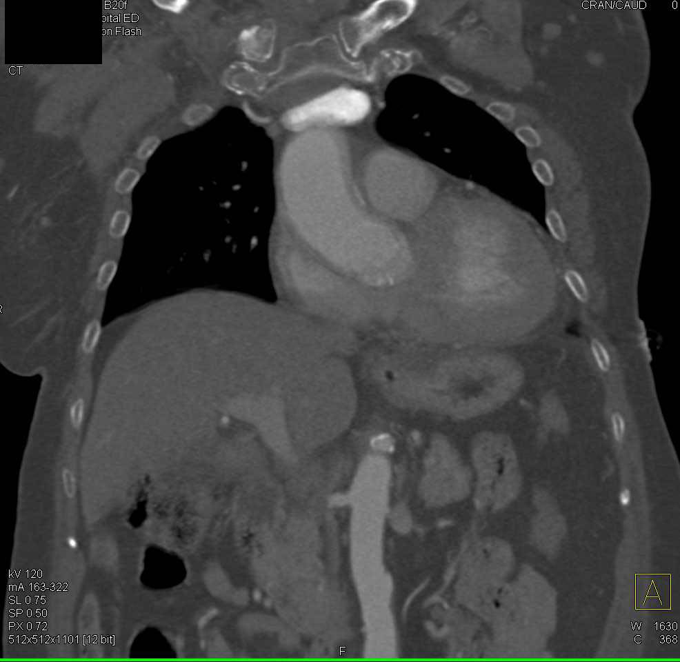 Fracture Head of Right Clavicle with Dislocation and Hematoma - CTisus CT Scan