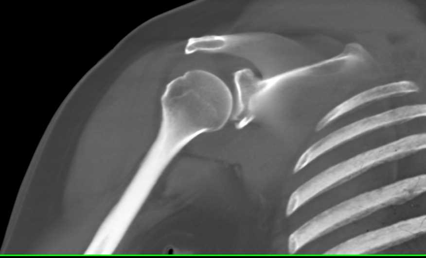 Fracture of Inferior Rim of the Glenoid - CTisus CT Scan