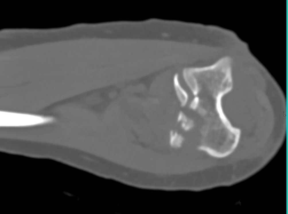 Comminuted Left Humeral Fracture - CTisus CT Scan