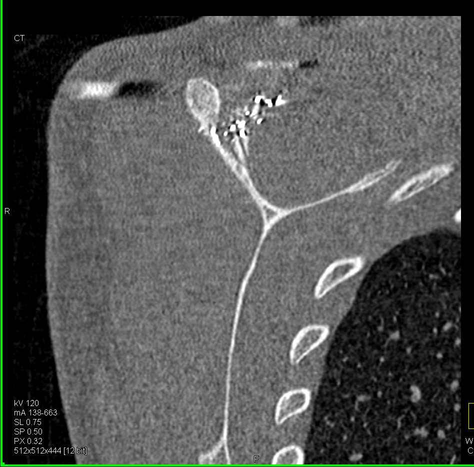 GSW with Scapular Fracture - CTisus CT Scan