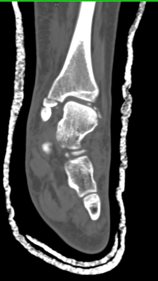 Ankle Fracture Including Talus Fracture - CTisus CT Scan