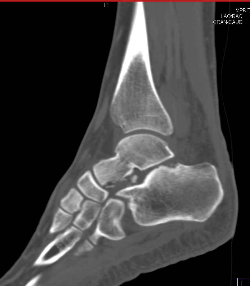 Fracture of the Talus and the Calcaneus - CTisus CT Scan