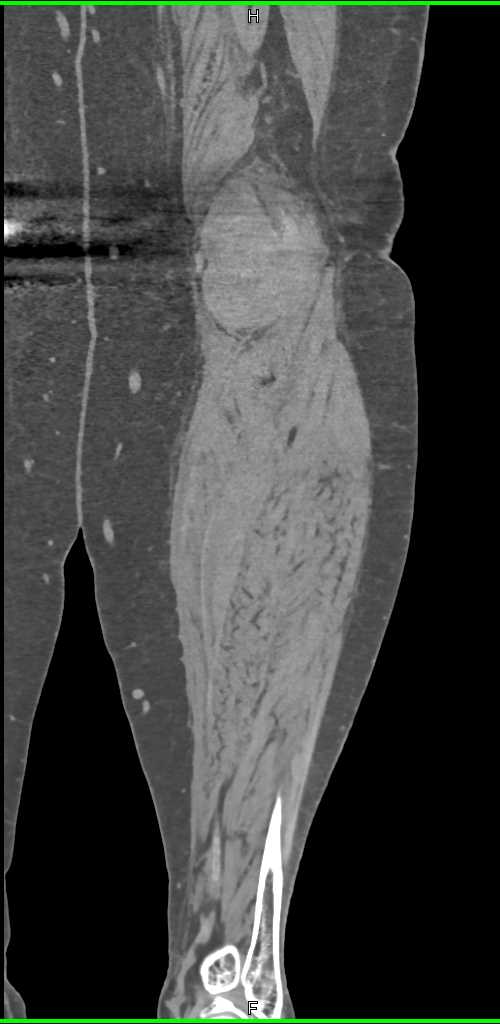 Trauma with Fracture and Lipohemarthrosis - CTisus CT Scan