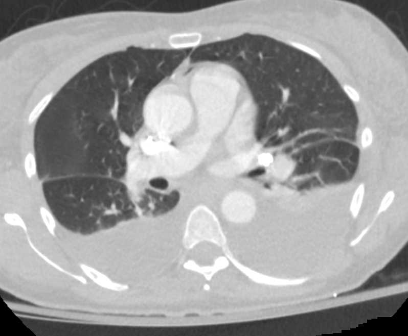 MVA with Left Renal Laceration - CTisus CT Scan