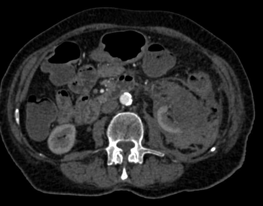 Trauma with Left Renal Laceration and Active Extravasation - CTisus CT Scan