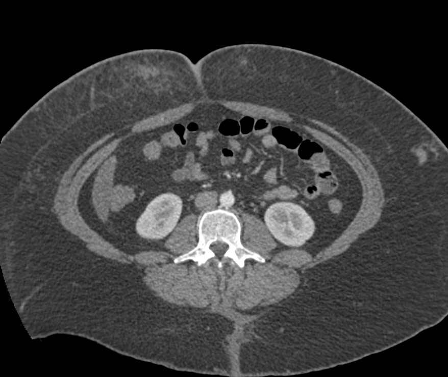 Seatbelt Injury in Subcutaneous Tissues of Abdominal Wall - CTisus CT Scan