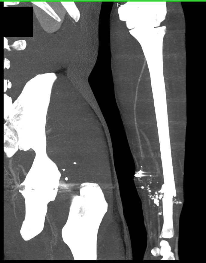 GSW Left rm with Injury to Left Radial and Ulnar Artery - CTisus CT Scan