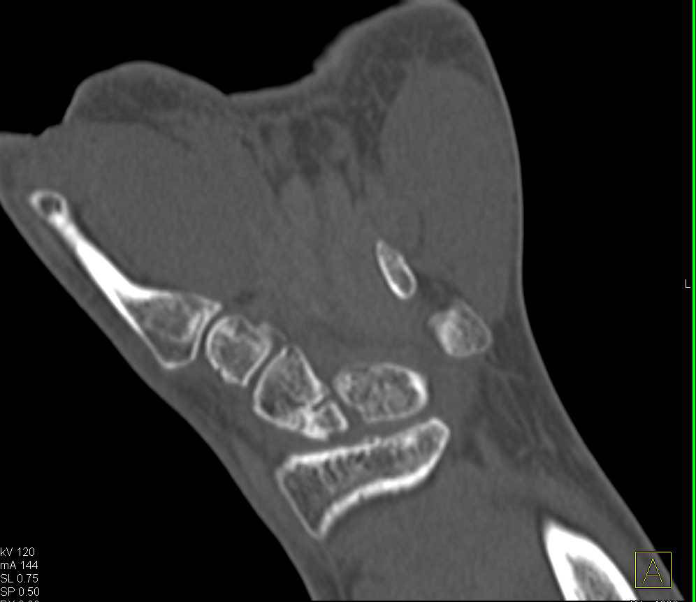 Nonunion of Scaphoid Fracture - CTisus CT Scan