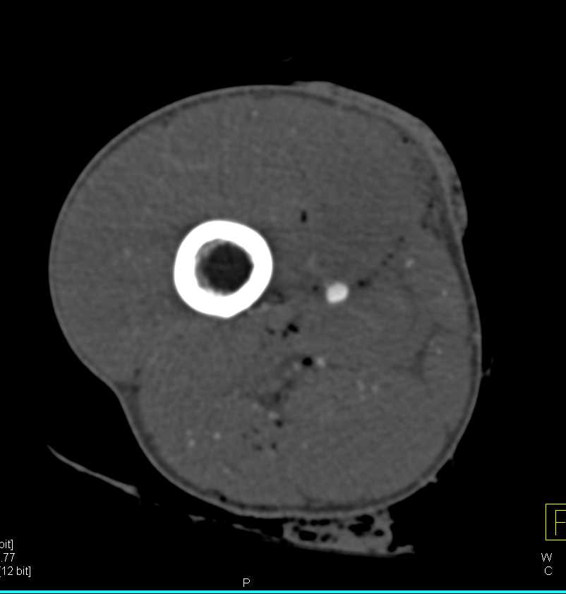 CTA with Laceration Superficial Femoral Artery (SFA) with Mid-Thigh Arteriovenous (AV) Fistulae - CTisus CT Scan