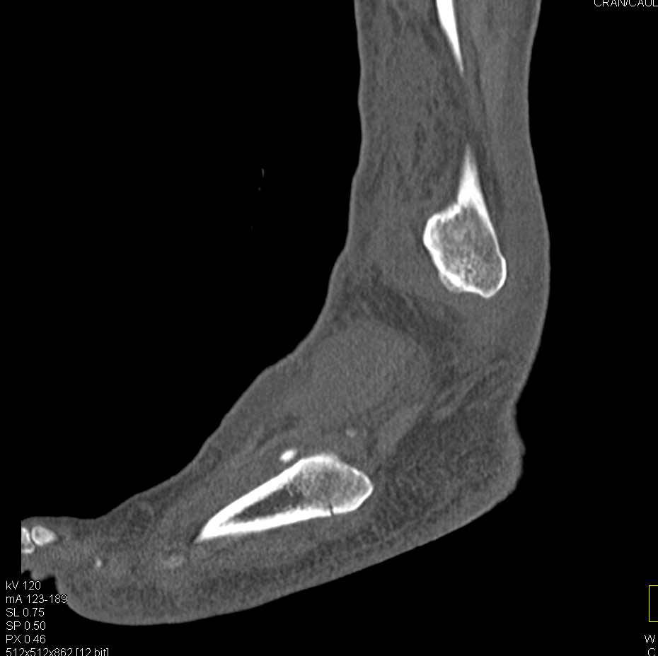 Fracture Base of the 5th Metatarsal - CTisus CT Scan