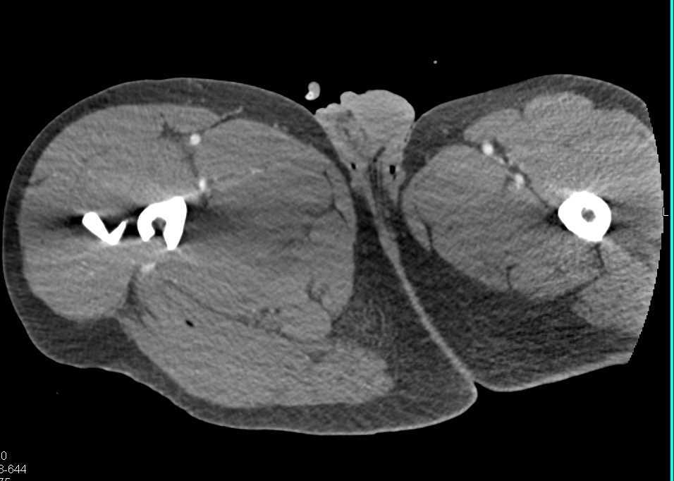 Comminuted Femur Fracture Without Vascular Injury - CTisus CT Scan