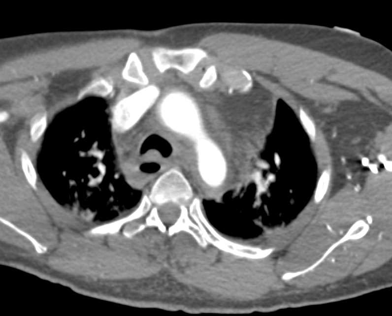 Laceration Descending Thoracic Aorta - CTisus CT Scan