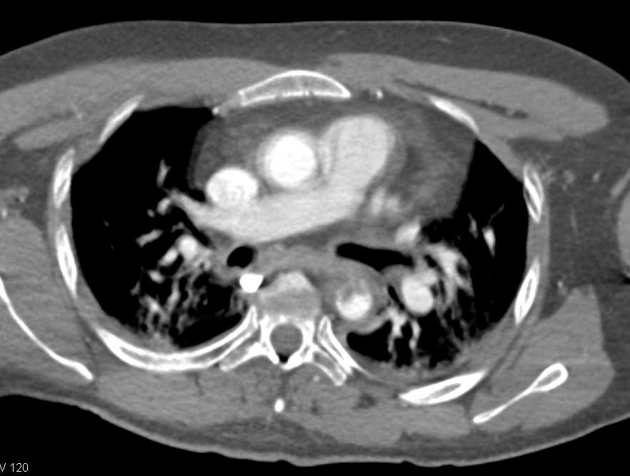 Laceration Descending Thoracic Aorta with Mediastinal Hematoma - CTisus CT Scan