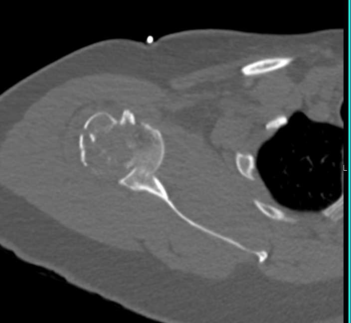 Fracture/Dislocation of the Right Shoulder - CTisus CT Scan