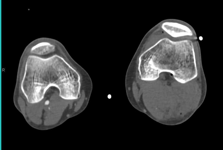 Fractures with Occlusion of the Superficial Femoral Artery (SFA) due to Trauma - CTisus CT Scan