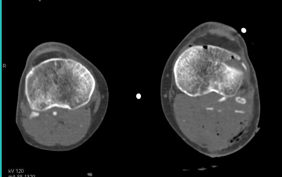 Fractures with Occlusion of the Superficial Femoral Artery (SFA) due to Trauma - CTisus CT Scan