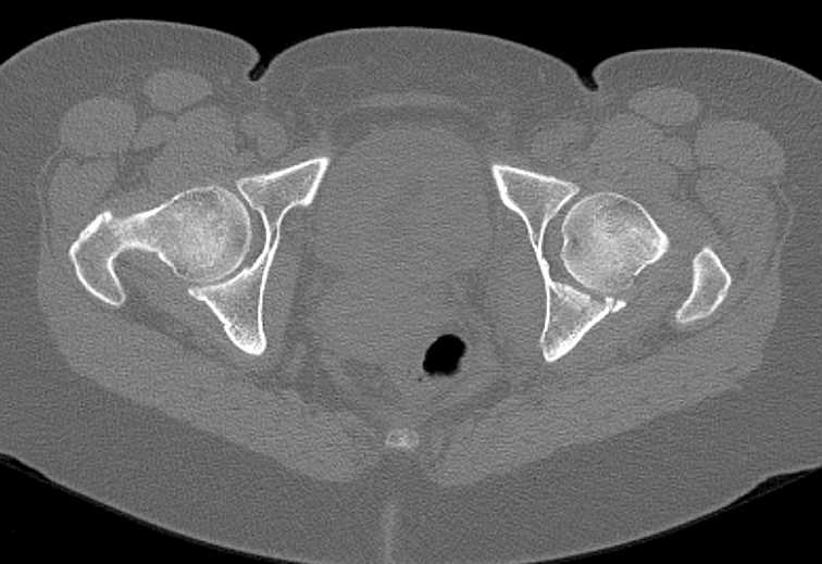 Fracture Posterior Column Left Acetabulum - CTisus CT Scan