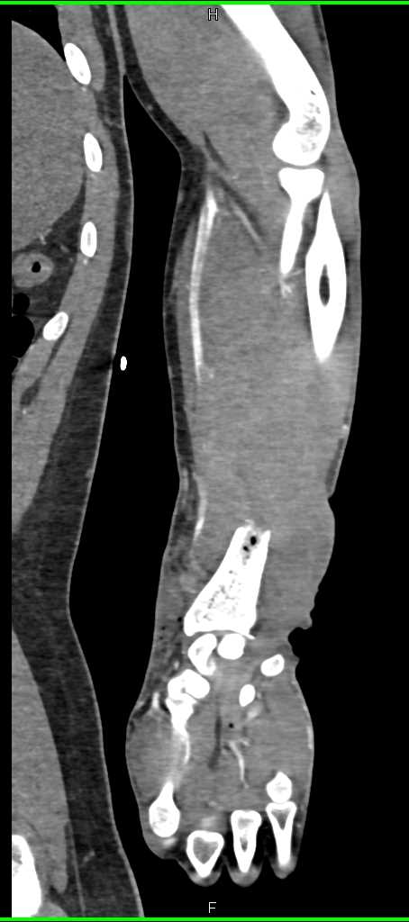 Distal Radius Fracture Without Vascular Injury - CTisus CT Scan