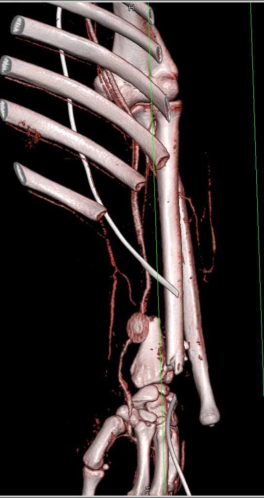 Distal Radius Fracture Without Vascular Injury - CTisus CT Scan