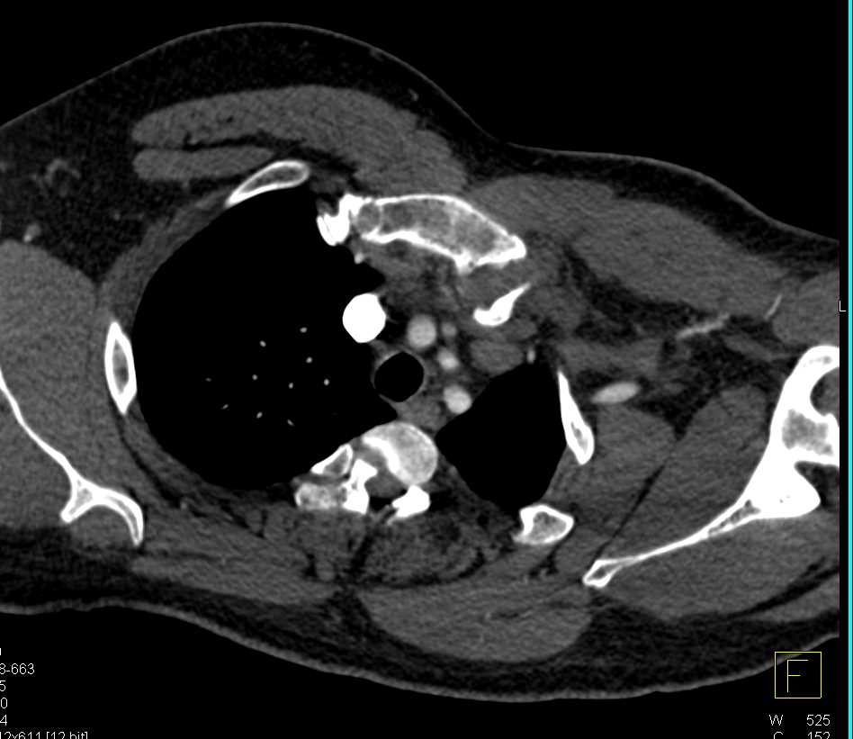 Patent Left Axillary and Brachial Artery Post Trauma - CTisus CT Scan