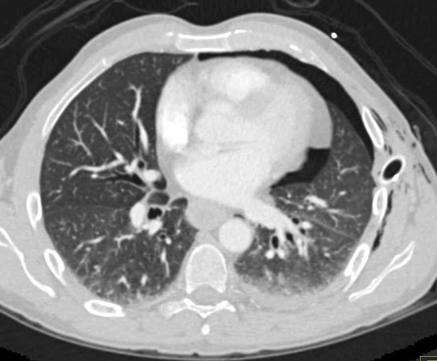 Post Trauma with Left Pneumothorax and Pneumoperitoneum - CTisus CT Scan