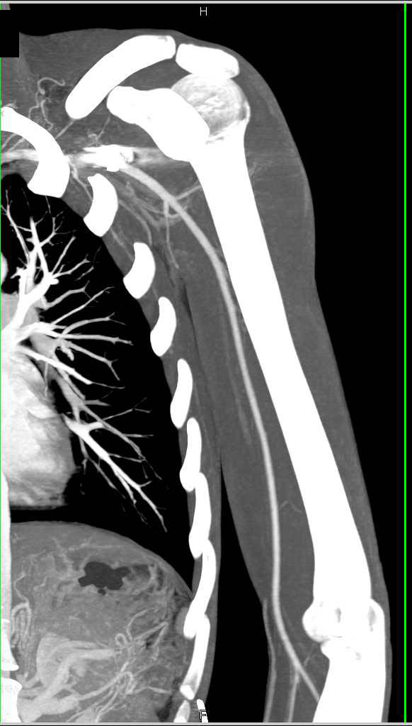 GSW Axilla Without Vascular Injury on the CTA - CTisus CT Scan