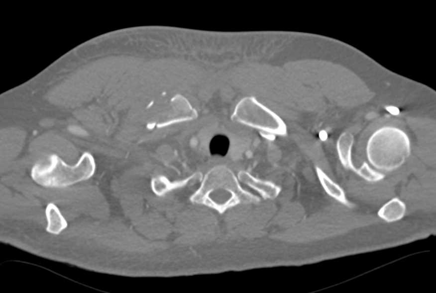 Right Clavicular Fracture - CTisus CT Scan