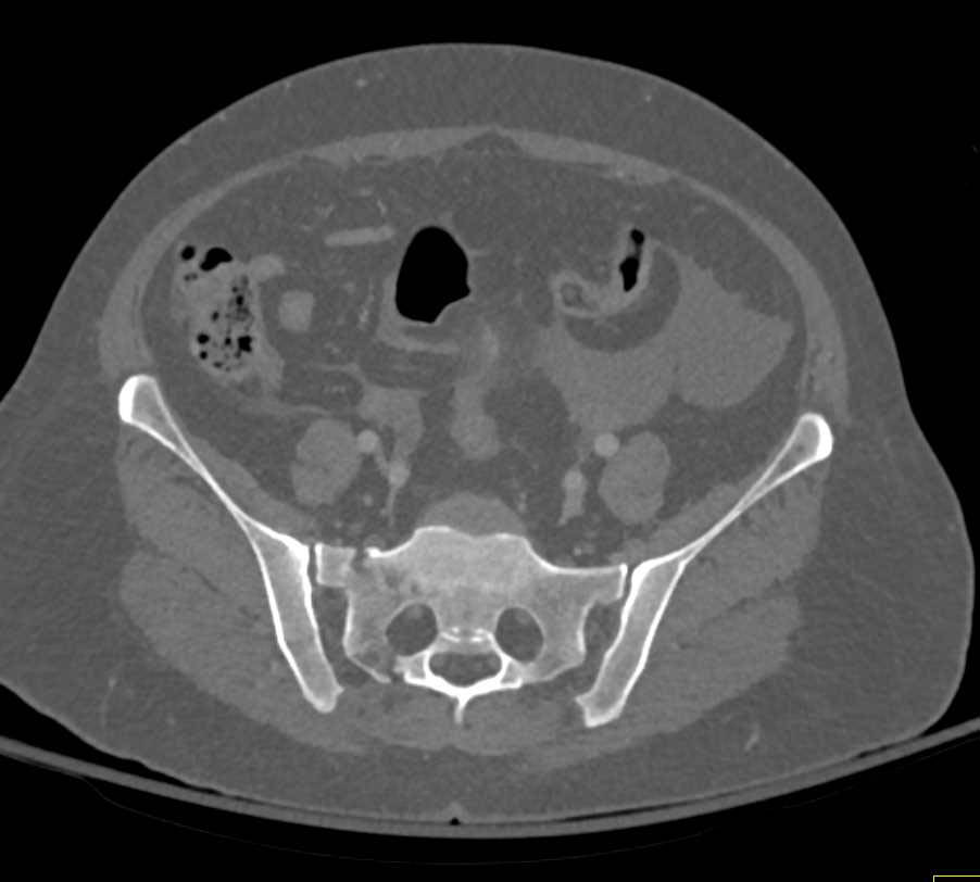 Sacral and Acetabular Fractures with Bladder Trauma and Pelvic Bleed - CTisus CT Scan