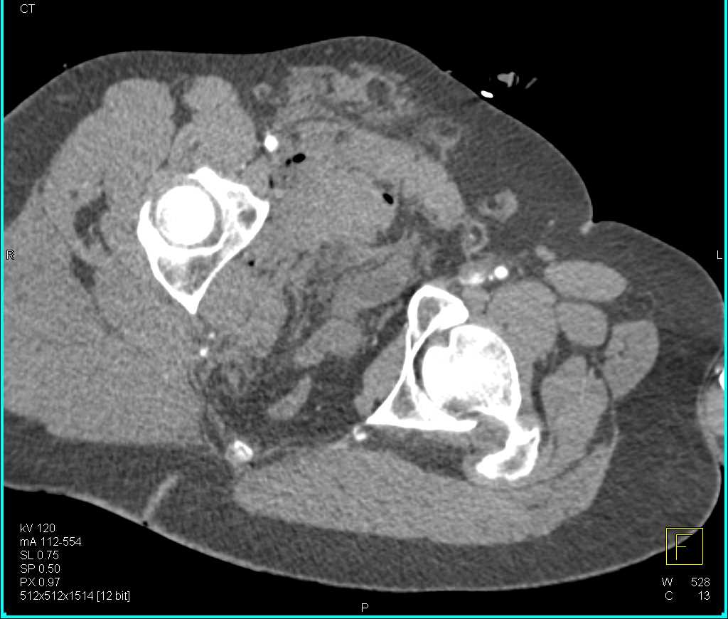 Pelvic Trauma with Bleed off Right Internal Iliac Artery - CTisus CT Scan