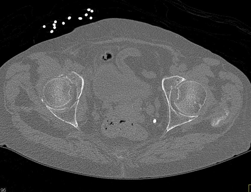 Subtle Fracture Anterior Column of Right Acetabulum - CTisus CT Scan