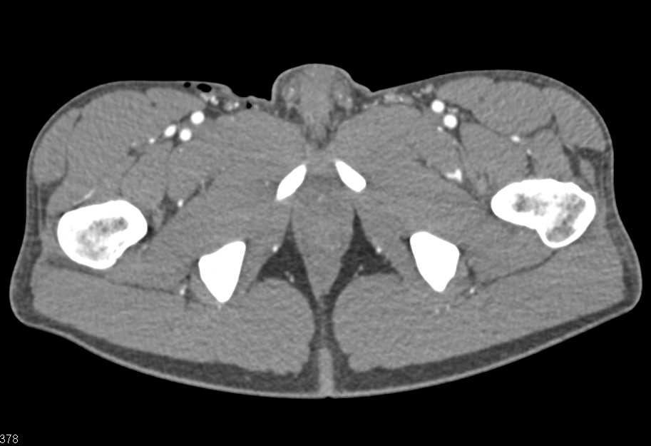 CTA Runoff without Vascular Injury - CTisus CT Scan