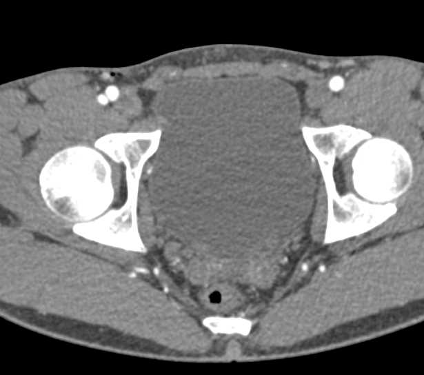 CTA Runoff without Vascular Injury Following Stabbing Right Groin - CTisus CT Scan