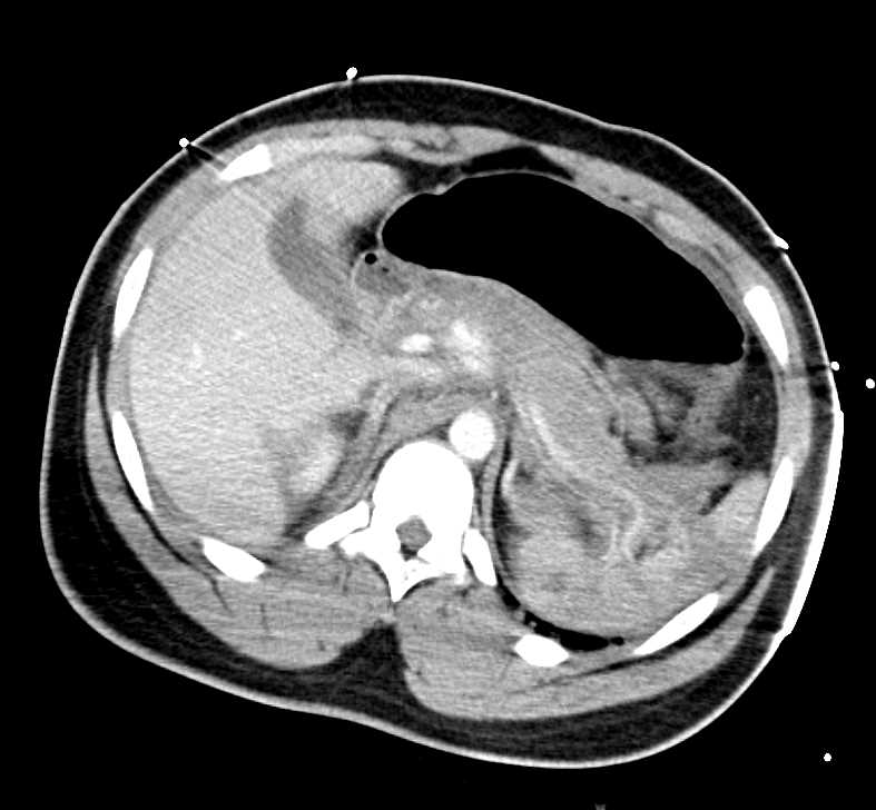 Complex Pelvic Fractures Including Sacrum and Left Hip Dislocation As Well As Multiorgan Involvement Including the Pancreas - CTisus CT Scan