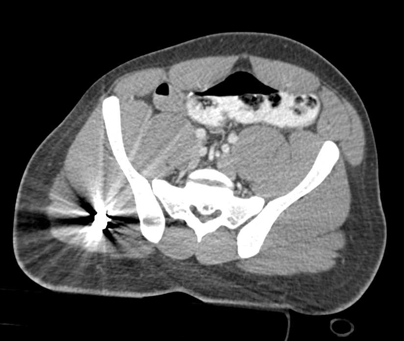 GSW Pelvis with Injury to Rectum Seen on the Study - CTisus CT Scan